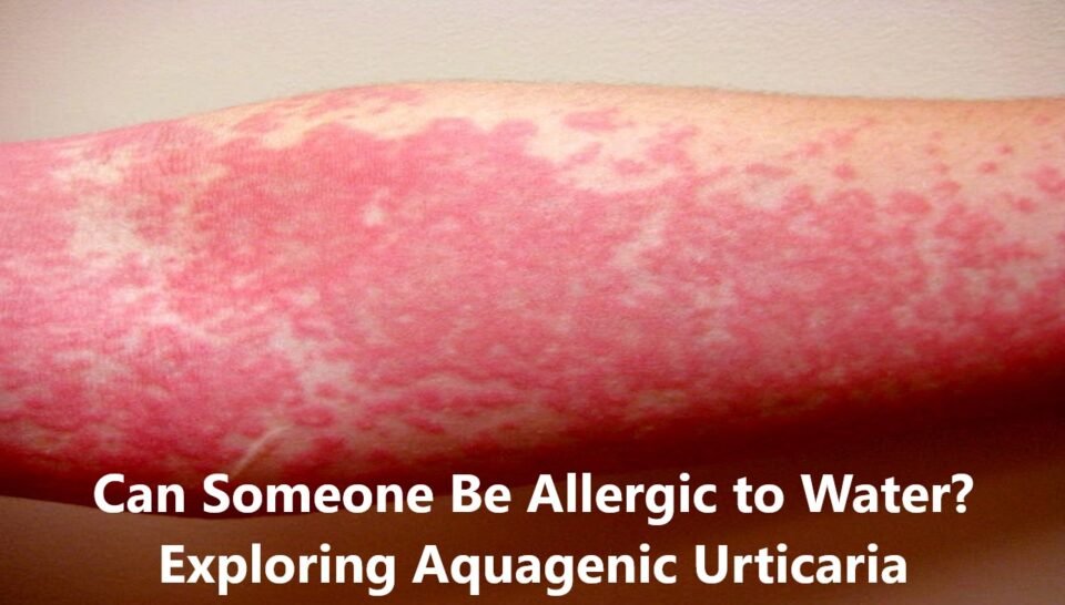 Can Someone Be Allergic to Water? Exploring Aquagenic Urticaria